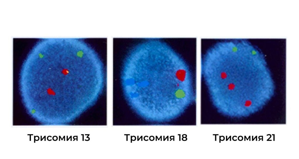 Аномалии хромосом 13, 18 и 21.